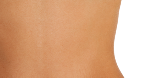 Cum scapam de vergeturi