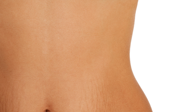 Cum scapam de vergeturi