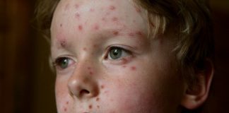 Bolile copilariei: varicela