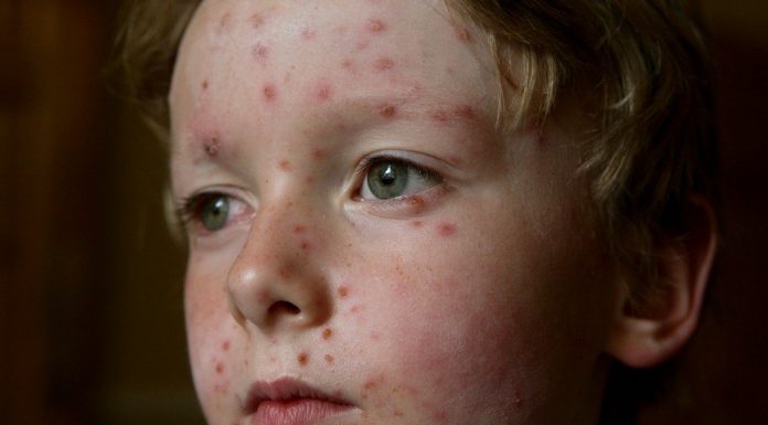 Bolile copilariei: varicela